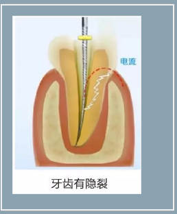 多頻技術(shù)的根管長(zhǎng)度測(cè)定儀