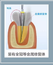 多頻技術(shù)的根管長(zhǎng)度測(cè)定儀