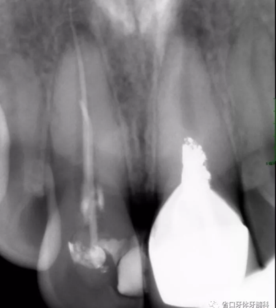 上前牙根管再治療后內(nèi)漂白1例 上前牙根管再治療后內(nèi)漂白1例