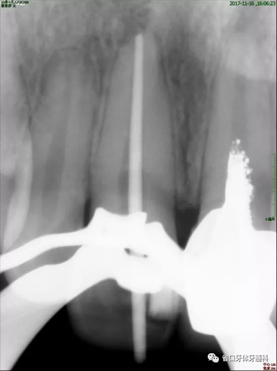 上前牙根管再治療后內(nèi)漂白1例 上前牙根管再治療后內(nèi)漂白1例