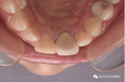 上前牙根管再治療后內(nèi)漂白1例 上前牙根管再治療后內(nèi)漂白1例