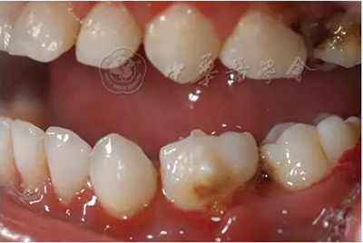 a【繼續(xù)教育園地】血液系統(tǒng)及骨骼系統(tǒng)疾病在兒童口腔中的表現(xiàn) a【繼續(xù)教育園地】血液系統(tǒng)及骨骼系統(tǒng)疾病在兒童口腔中的表現(xiàn)