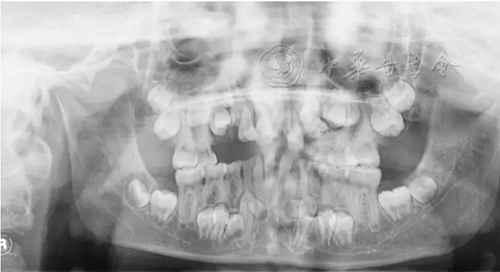 【繼續(xù)教育園地】血液系統(tǒng)及骨骼系統(tǒng)疾病在兒童口腔中的表現(xiàn) 【繼續(xù)教育園地】血液系統(tǒng)及骨骼系統(tǒng)疾病在兒童口腔中的表現(xiàn)