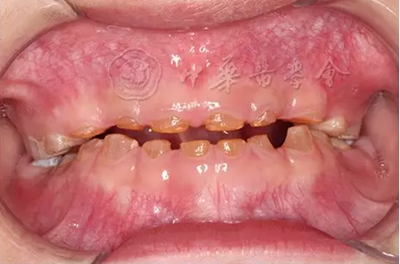 【繼續(xù)教育園地】血液系統(tǒng)及骨骼系統(tǒng)疾病在兒童口腔中的表現(xiàn) 【繼續(xù)教育園地】血液系統(tǒng)及骨骼系統(tǒng)疾病在兒童口腔中的表現(xiàn)