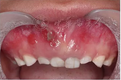 【繼續(xù)教育園地】血液系統(tǒng)及骨骼系統(tǒng)疾病在兒童口腔中的表現(xiàn) 【繼續(xù)教育園地】血液系統(tǒng)及骨骼系統(tǒng)疾病在兒童口腔中的表現(xiàn)