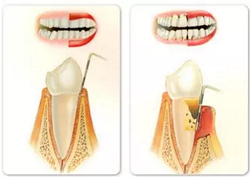 上海嘉?？谇谎芯克皇兰o(jì)牙周病的臨床進(jìn)展