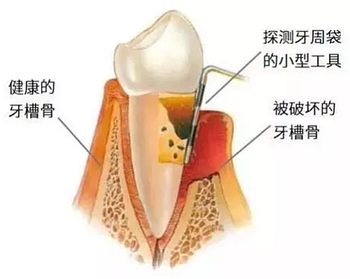 上海嘉?？谇谎芯克皇兰o(jì)牙周病的臨床進(jìn)展