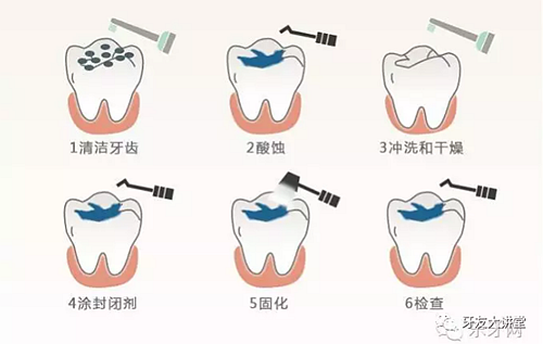 窩溝封閉劑