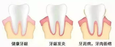 牙周炎，中國成年人后半生永遠的 痛 ！