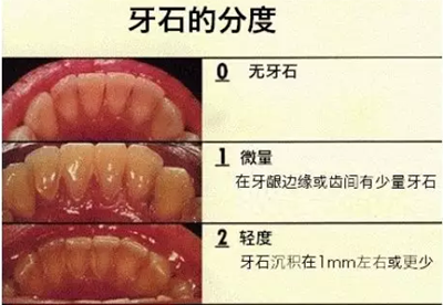 牙周炎，中國成年人后半生永遠的 痛 ！