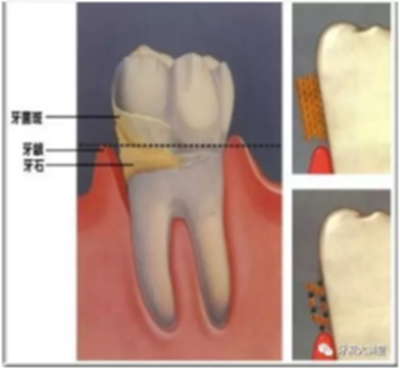 牙周炎，中國成年人后半生永遠的 痛 ！