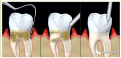 牙周炎，中國成年人后半生永遠的 痛 ！