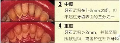 牙周炎，中國成年人后半生永遠的 痛 ！