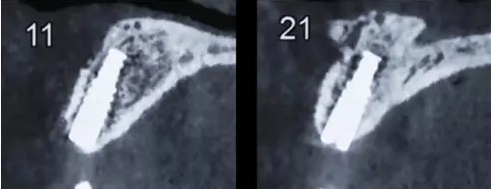Asc全瓷角度基臺一體冠進行種植前牙美學(xué)修復(fù)一例