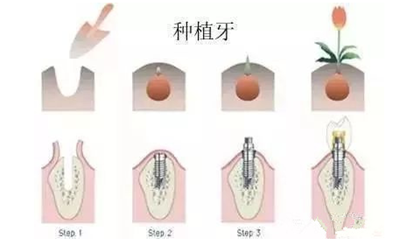 延長種植牙使用壽命的方法