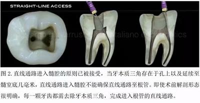 【病例分享】根管冠部預(yù)敞