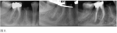 【病例分享】根管冠部預(yù)敞