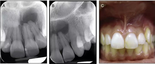 【病例分享】治療后的根尖周炎與根尖外的獨(dú)立感染