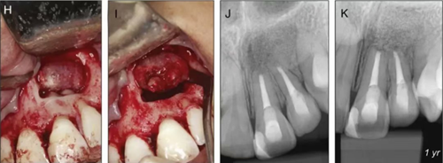 【病例分享】治療后的根尖周炎與根尖外的獨(dú)立感染