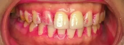 牙菌斑是什么？