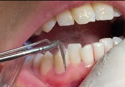 牙菌斑是什么？