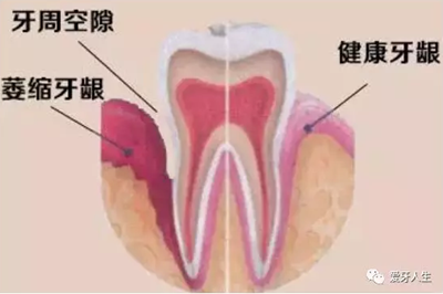 什么是牙齦萎縮？