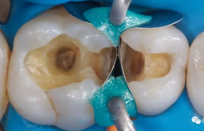 復(fù)合樹脂直接粘接牙體修復(fù)技術(shù)臨床常見問題及處理 復(fù)合樹脂直接粘接牙體修復(fù)技術(shù)臨床常見問題及處理