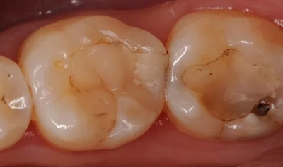 復(fù)合樹脂直接粘接牙體修復(fù)技術(shù)臨床常見問題及處理 復(fù)合樹脂直接粘接牙體修復(fù)技術(shù)臨床常見問題及處理