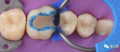 復(fù)合樹脂直接粘接牙體修復(fù)技術(shù)臨床常見問題及處理 復(fù)合樹脂直接粘接牙體修復(fù)技術(shù)臨床常見問題及處理