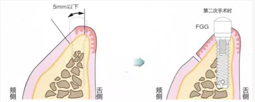 種植體周圍角化齦的獲得時期與方法