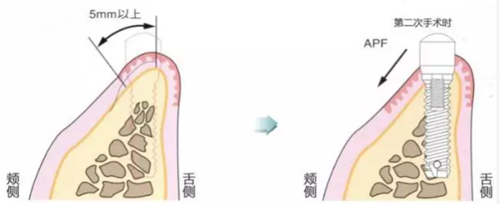 種植體周圍角化齦的獲得時期與方法