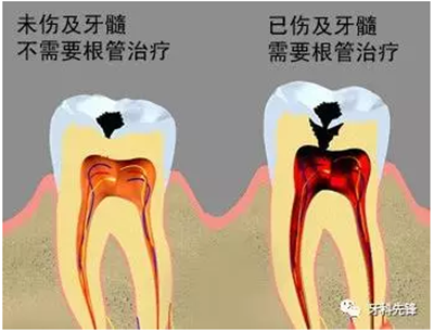 補牙不做冠，療效少一半！根管治療后牙齒已經(jīng)不疼了，為什么還要戴牙冠呢？