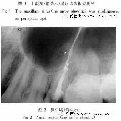 X線牙片在牙齒疑難病例診斷中的參考價(jià)值