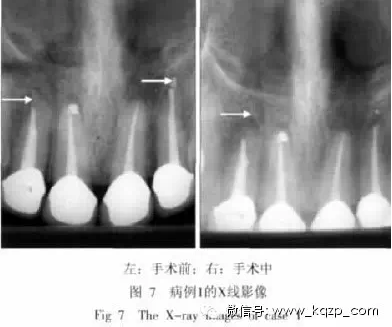 X線牙片在牙齒疑難病例診斷中的參考價(jià)值