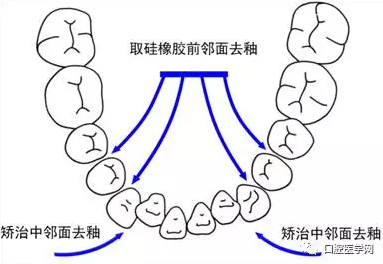 鄰面去釉技術(shù)詳解