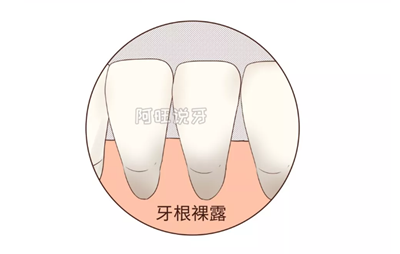 那什么拯救你，我的牙齦萎縮！