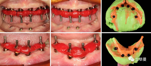 【病例分享】應(yīng)用全程數(shù)字化對(duì)牙周炎患者實(shí)現(xiàn)全口即刻種植即刻修復(fù)