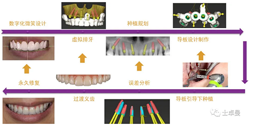 【病例分享】應(yīng)用全程數(shù)字化對(duì)牙周炎患者實(shí)現(xiàn)全口即刻種植即刻修復(fù)