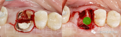 后牙區(qū)即刻種植臨床指南