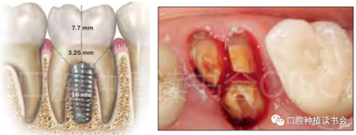 后牙區(qū)即刻種植臨床指南