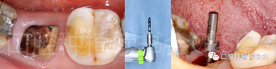 后牙區(qū)即刻種植臨床指南