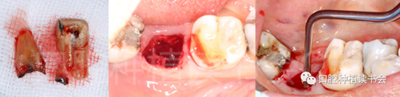 后牙區(qū)即刻種植臨床指南