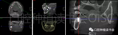 后牙區(qū)即刻種植臨床指南