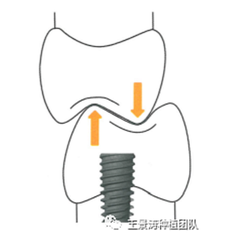 后牙區(qū)即刻種植的適應(yīng)癥的思考