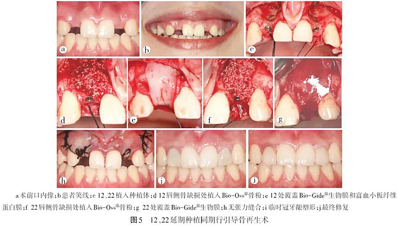 3    結(jié)語          前牙美學(xué)區(qū)種植治療需考慮眾多因素，醫(yī)生需根據(jù)患者的自身?xiàng)l件、擬種植區(qū)的軟硬組織情況綜合分析，正確選擇種植時機(jī)，配合軟硬組織增量手術(shù)，最終將種植體植入理想部位。在美學(xué)區(qū)條件嚴(yán)格滿足適應(yīng)證的情況下，優(yōu)先考慮即刻或早期種植。若采取延期種植，可考慮先行牙槽嵴保存術(shù)后再進(jìn)行種植。目前關(guān)于美學(xué)區(qū)不同種植時機(jī)臨床療效的對比研究尚無統(tǒng)一結(jié)論，相關(guān)系統(tǒng)評價性文章異質(zhì)性較大，因此前牙區(qū)種植時機(jī)的選擇對臨床療效的影響仍有待研究。 參考文獻(xiàn)  略