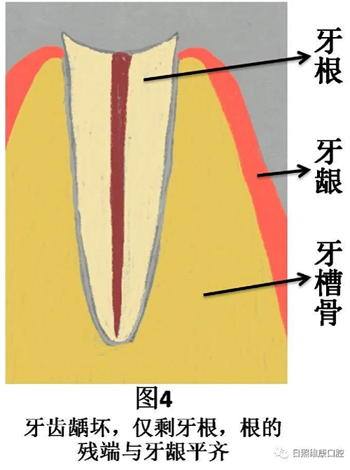 口腔科普 | 殘根殘冠怎么辦——樁核冠